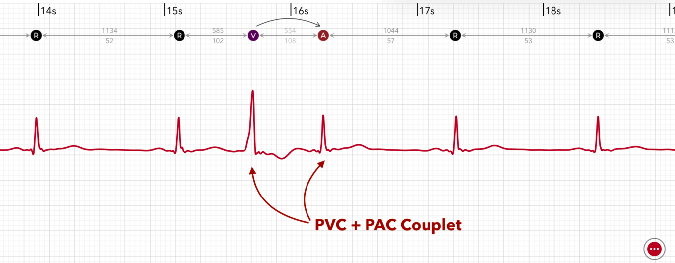 ECG+ app showing PAC and PVC couplets, two premature beats in a row on an Apple Watch ECG