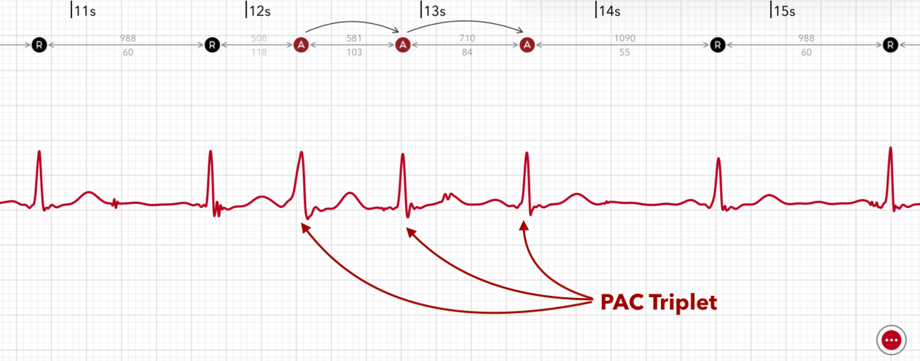 ECG+ app showing a PAC triplet, three premature beats in a row on an Apple Watch ECG
