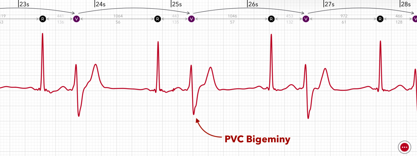 ECG+ app showing PVC bigeminy, every second beat is a premature ventricular contraction on an Apple Watch ECG