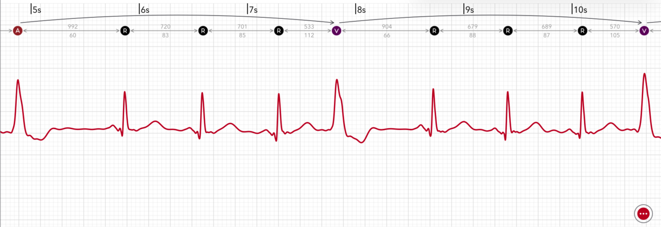 ECG+ app showing PVC quadrigeminy, every fourth beat is a premature ventricular contraction on an Apple Watch ECG