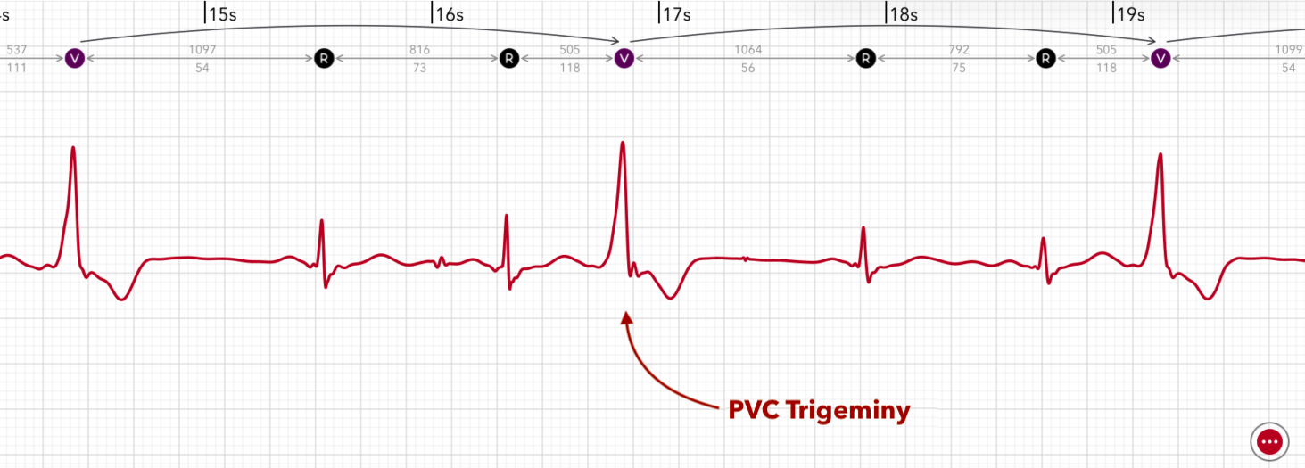 ECG+ app showing PVC trigeminy, every third beat is a premature ventricular contraction on an Apple Watch ECG
