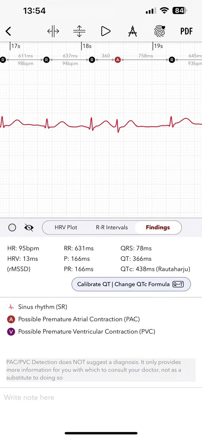 An early ECG+ screen from 2021 showing the on-strip R, A and V beat markers, R-R intervals, and the findings panel with PAC and PVC detection