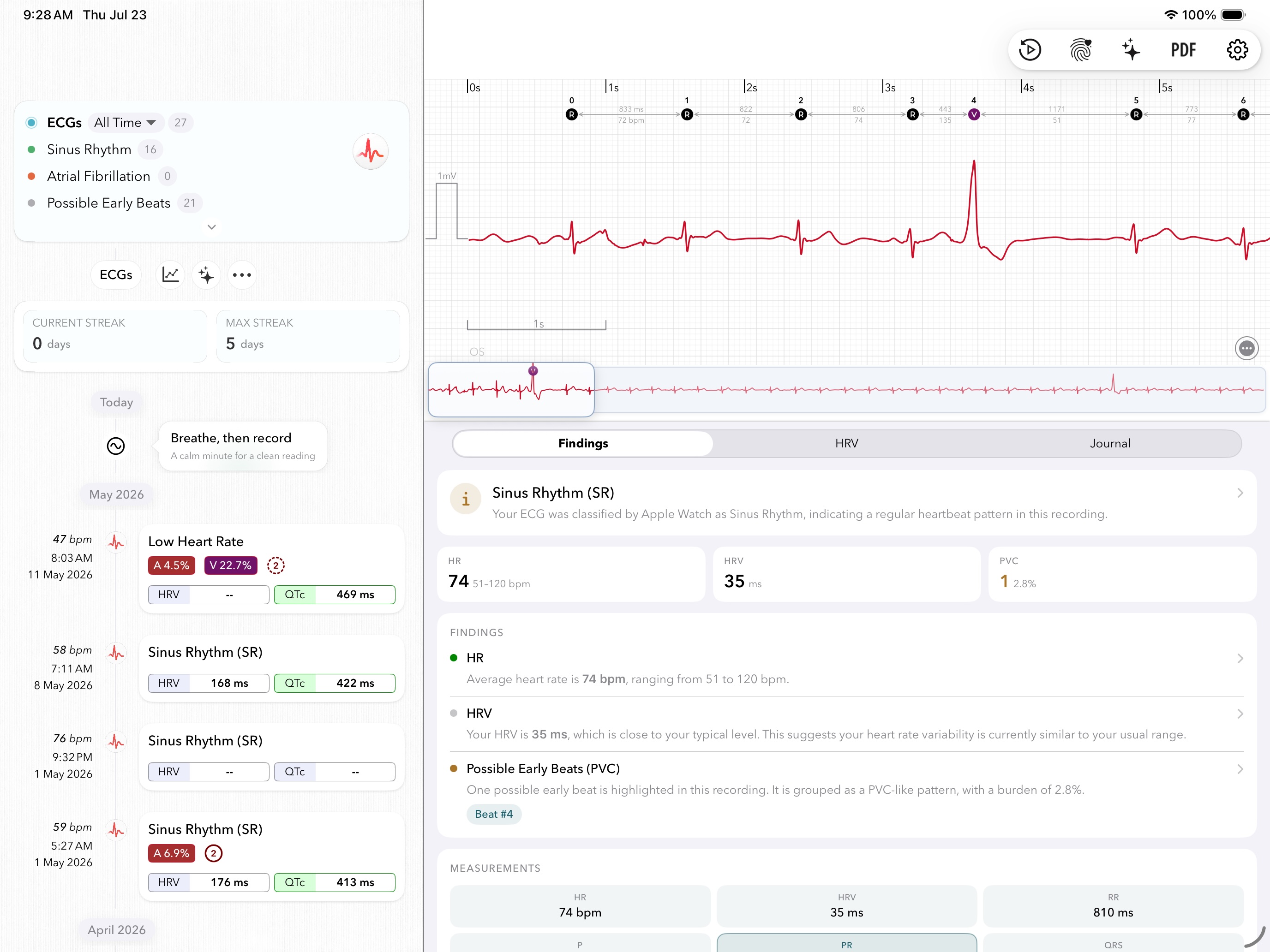 ECG+ running full-screen on an iPad: a timeline of past recordings on the left, and on the right a single Apple Watch ECG with each beat annotated (R/A/V markers, RR intervals), the beat navigator, and a findings panel showing sinus rhythm, heart rate, HRV and a PVC