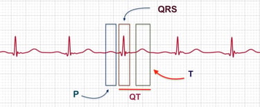 Apple Watch ECG wave diagram labeling the P wave, QRS complex, T wave, and QT interval in ECG+ app