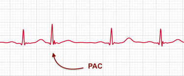 ECG strip showing a premature atrial contraction or PAC on an Apple Watch ECG report
