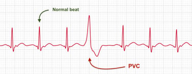 ECG strip showing a premature ventricular contraction (PVC) compared to a normal heartbeat