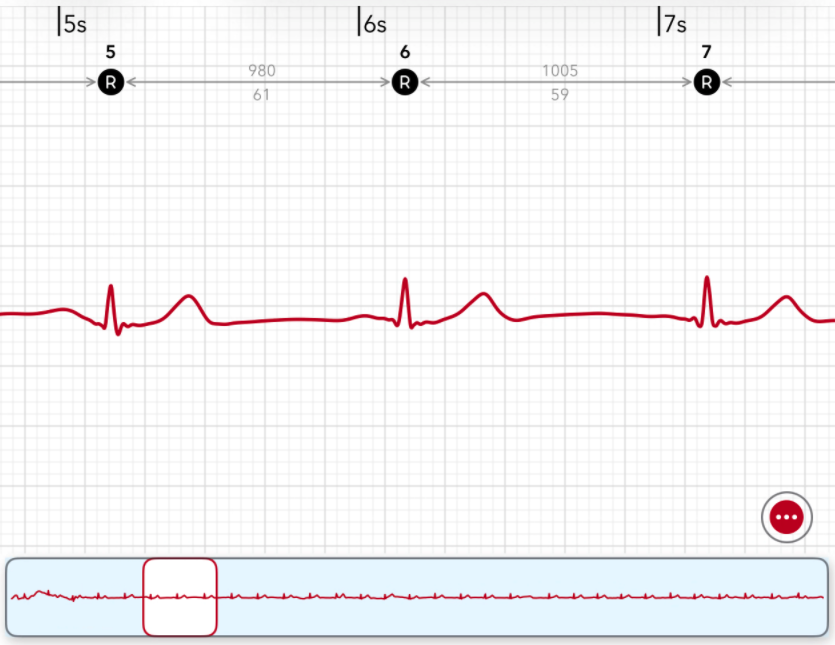 An Apple Watch ECG strip in ECG+ with each heartbeat marked by a dotted R icon, numbered, and labelled with the RR interval in milliseconds and the heart rate between beats