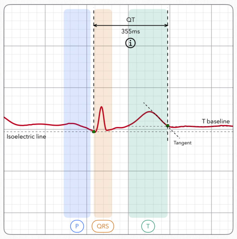 A Heartbeat Signature with the P wave, QRS complex and T wave regions highlighted, plus the QT interval and baseline