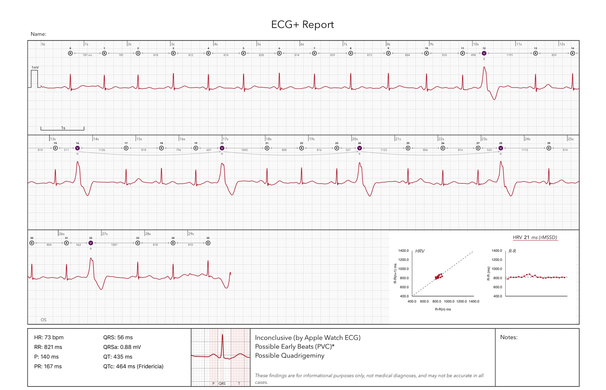 An inconclusive result on an Apple Watch ECG recording