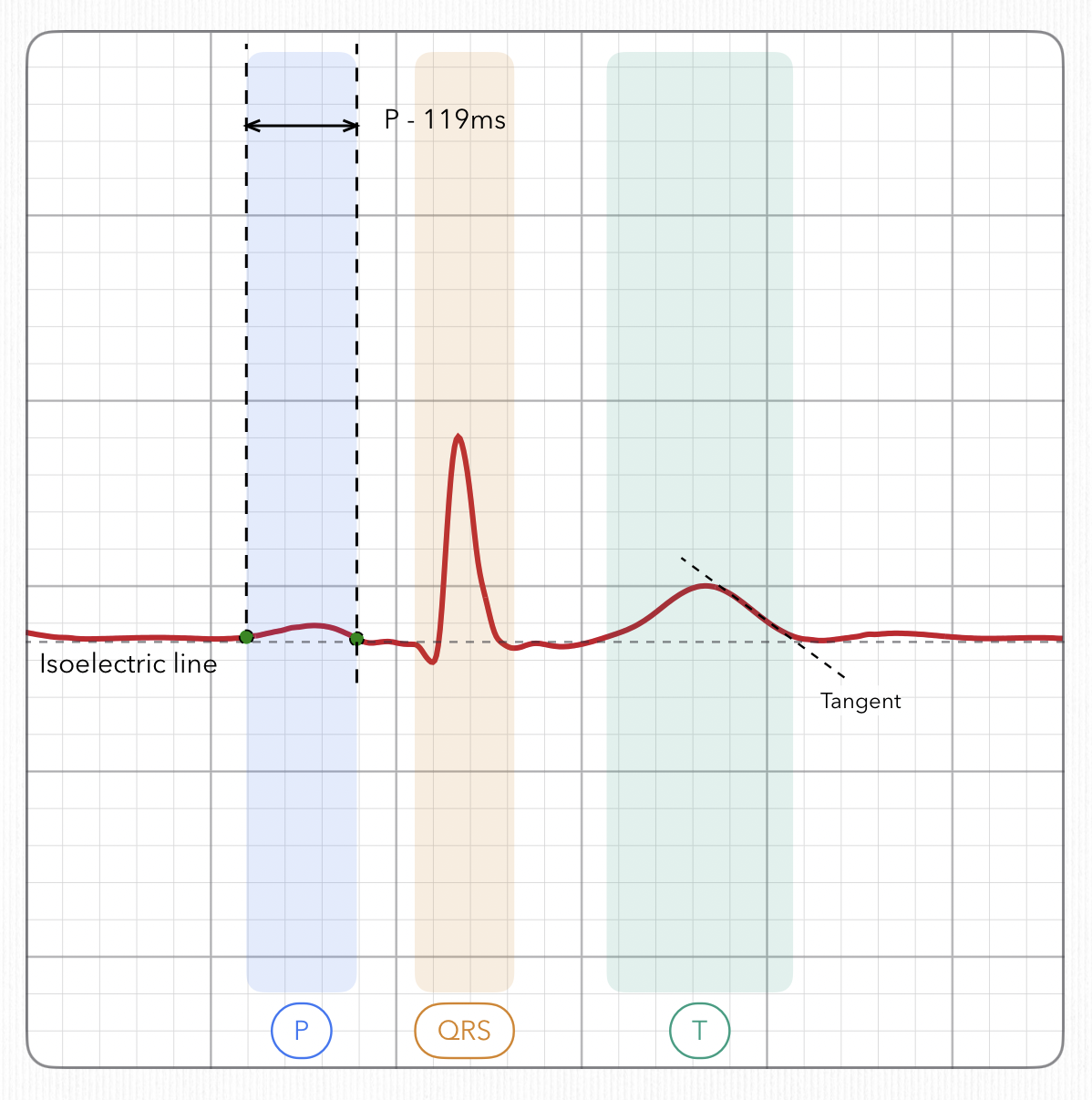 One heartbeat with the P, QRS and T segments shaded: the P wave is a barely visible rise above the isoelectric line, next to a QRS spike many times taller