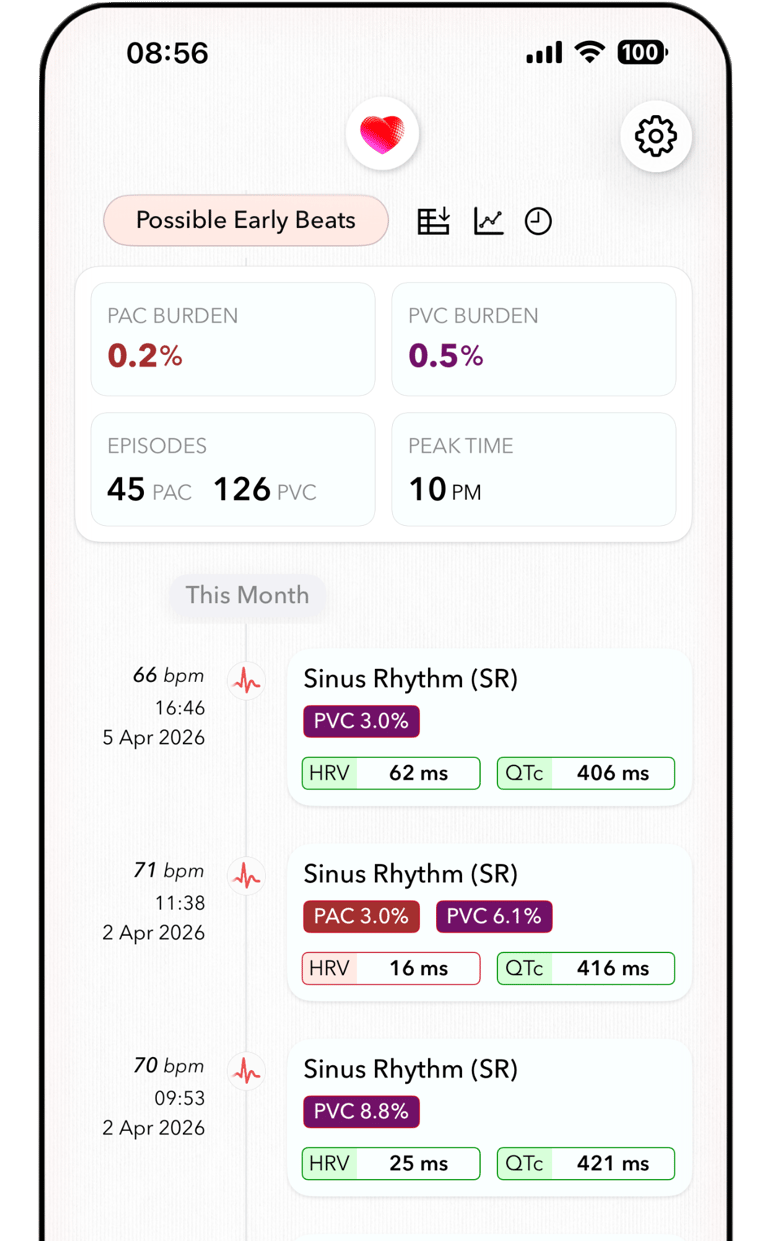 ECG+ app screenshot showing PAC burden calculated for Apple Watch ECG recordings