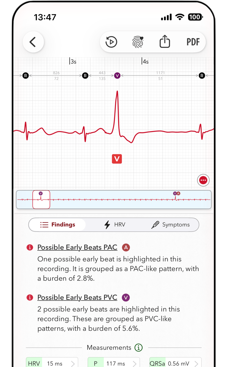 ECG+ app screenshot showing a PVC beat is marked on an Apple Watch ECG report