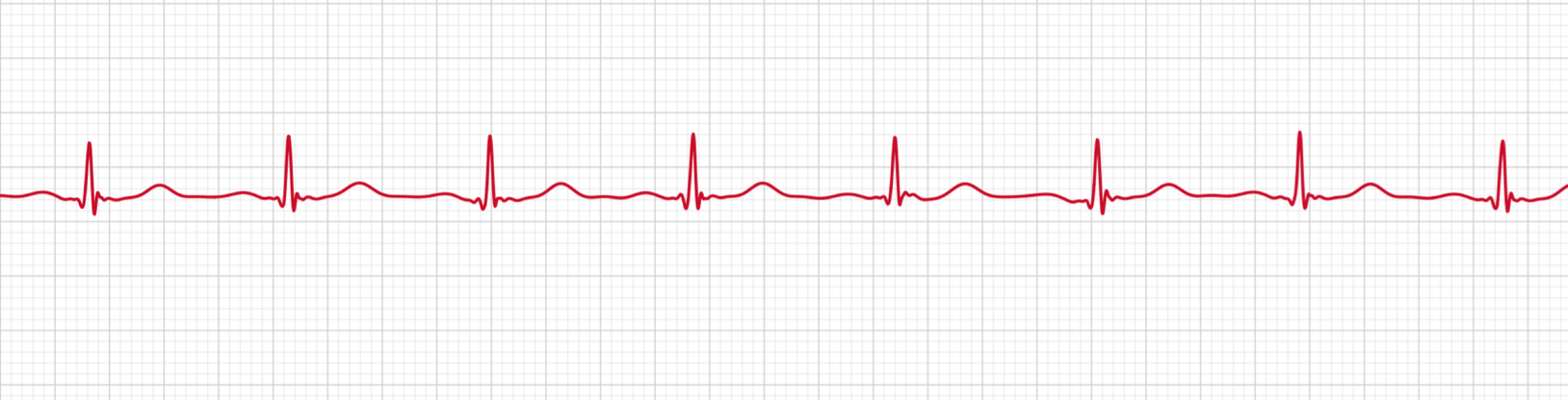 A normal sinus rhythm on an Apple Watch ECG, regular, evenly spaced beats each with an upright P wave